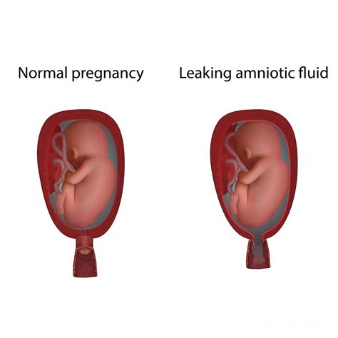 pregnant leaking fluid|Leaking Amniotic Fluid During Pregnancy